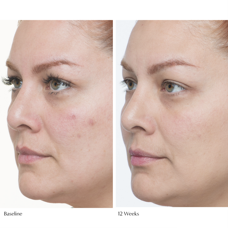 Woman's face showing 12 week results of using Plumscreen